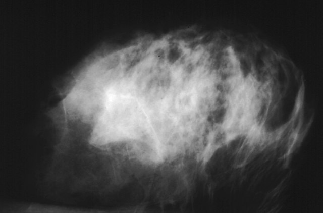 Abnormal mammogram